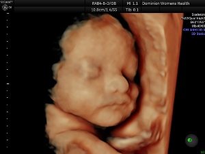 4D ultrasound