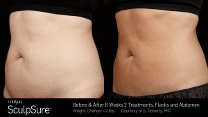 SculpSure at Dominion Women's Health